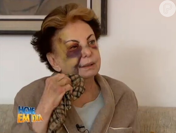 Beatriz Segall tropeçou em uma calçada na Gávea, Zona Sul do Rio de Janeiro, e machucou o olho direito