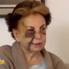 Beatriz Segall exibiu os hematomas pelo rosto durante a entrevista
