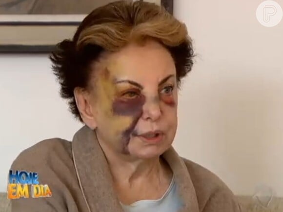 Beatriz Segall exibiu os hematomas pelo rosto durante a entrevista