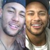 Neymar ficou com o rosto levemente inchado após o procedimento