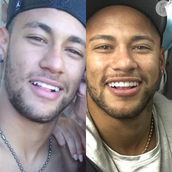 Neymar ficou com o rosto levemente inchado após o procedimento