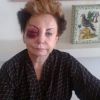 Em 2013, a atriz levou um tombo em uma no Rio de Janeiro e machucou bastante o rosto
