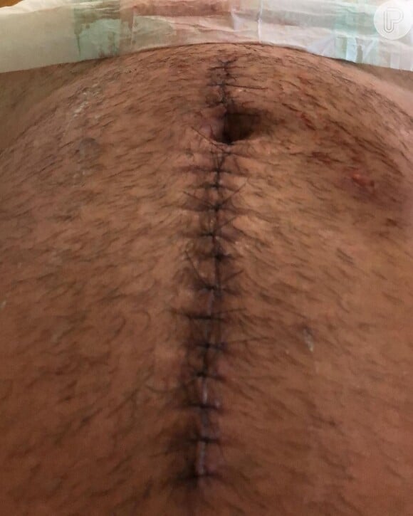 Borat, de 'Amor & Sexo', mostrou pontos na barriga após levar tiro