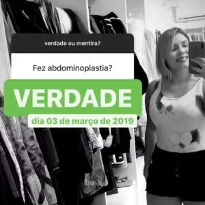 Marília Mendonça assume que fez abdominoplastia