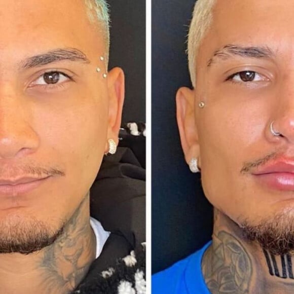 'A Fazenda 13': Dynho Alves excluiu publicação de antes e depois por harmonização facial logo após fãs apontarem o reality show