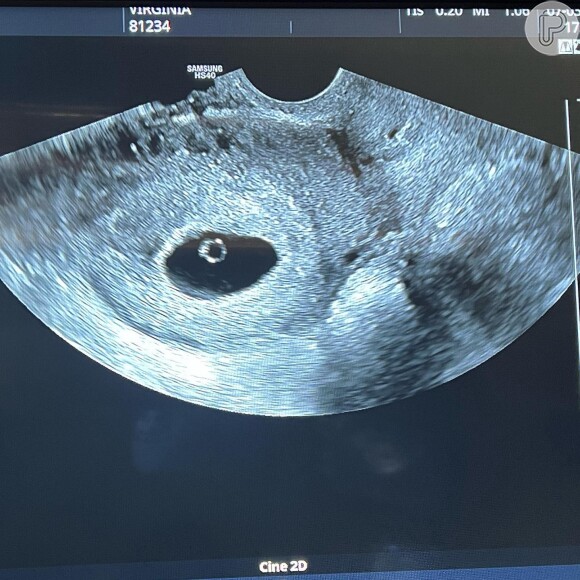 Virgínia Fonseca mostra foto do primeiro ultrassom feito após anunciar nova gravidez