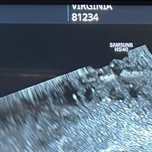 Virgínia Fonseca mostrou ultrassom da nova gravidez e explicou que segundo filho ainda é um embrião