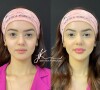 Harmonização facial de Eslovênia, do 'BBB 22': miss realizou mudanças para diminuir as olheiras e realçar os traços naturais do rosto