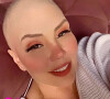 Careca, Simony mostra cabeça raspada após fim de tratamento contra o câncer