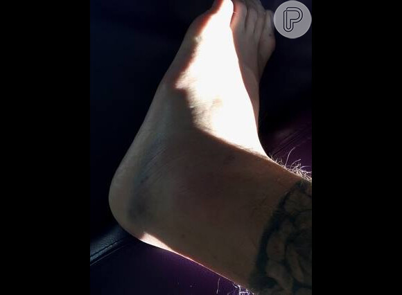 Justin Bieber mostrou uma foto do pé quebrado nas redes sociais e escreveu: 'Quebrei meu maldito pé'