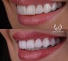 Ex-BBB Larissa Santos mostrou o antes e depois da troca das lentes nos dentes