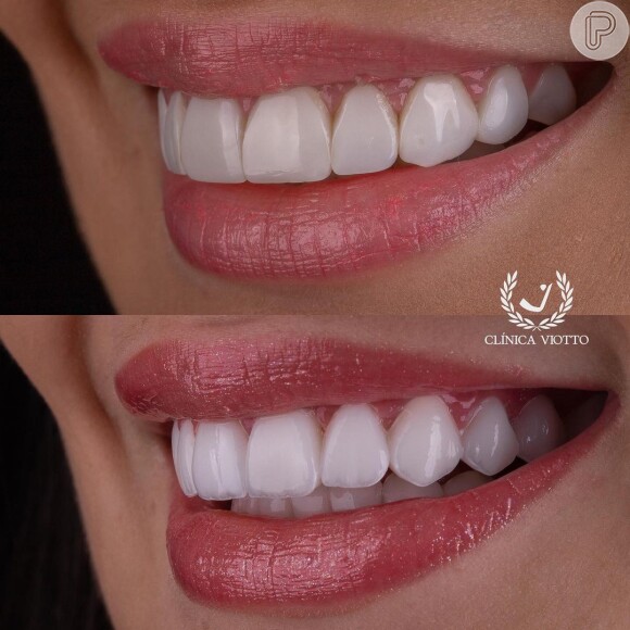 Ex-BBB Larissa Santos mostrou o antes e depois da troca das lentes nos dentes