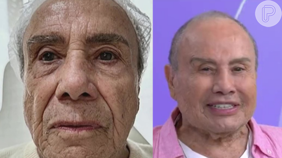 Stenio Garcia faz harmonização facial: veja antes e depois