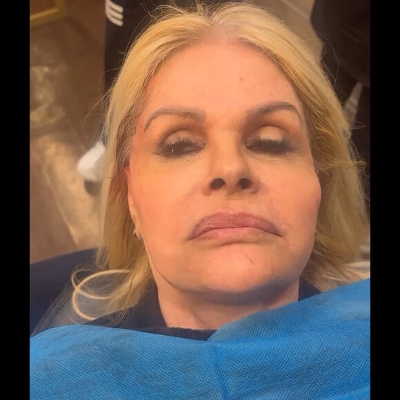 Monique Evans compartilhou vídeo de momentos antes de passar por harmonização facial