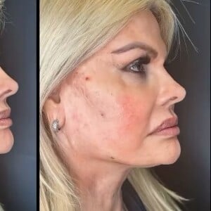 Harmonização facial de Monique Evans: antes e depois da modelo surpreendeu