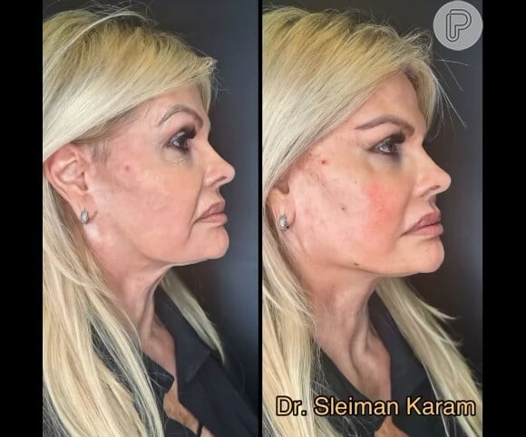 Harmonização facial de Monique Evans: antes e depois da modelo surpreendeu