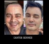 Harmonização facial de Renner: veja antes e depois