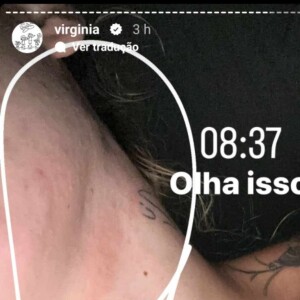 Virginia Fonseca mostra corpo marcado por alergia para contar como está se sentindo