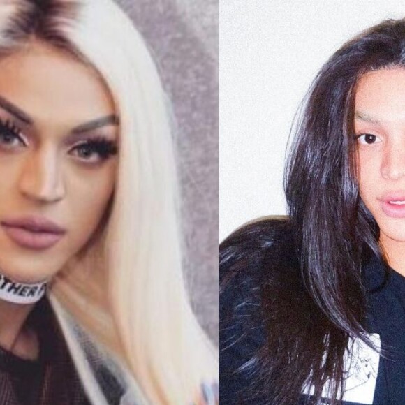 Assim como Rafa Justus, Pabllo Vittar também precisou corrigir um desvio de septo, e aproveitou pata diminuir seu nariz