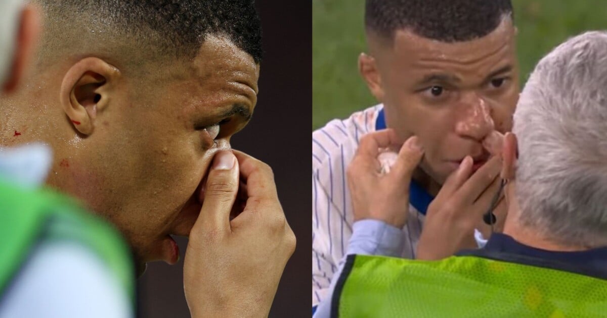 Bizarre! Mbappé a le nez « tordu » et en sang après une collision avec un autre joueur : « Comme un L »