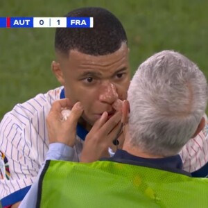 Nariz de Mbappé ficou 'torto' após atacante se chocar com outro jogador na Eurocopa