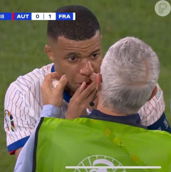 Nariz de Mbappé ficou 'torto' após atacante se chocar com outro jogador na Eurocopa