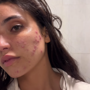 Ainda nesta semana, Vanessa Lopes usou suas redes sociais para mostrar sua pele real com acnes