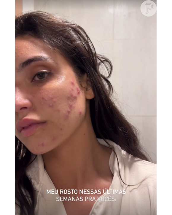 Ainda nesta semana, Vanessa Lopes usou suas redes sociais para mostrar sua pele real com acnes