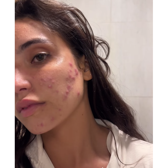 Ainda nesta semana, Vanessa Lopes usou suas redes sociais para mostrar sua pele real com acnes