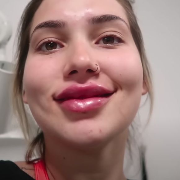 Em 2018, Virgínia Fonseca realizou um preenchimento labial