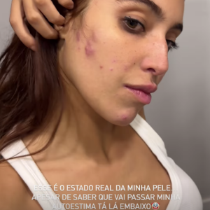 Vanessa Lopes atualizou suas redes sociais com um vídeo exibindo a atual situação do seu rosto