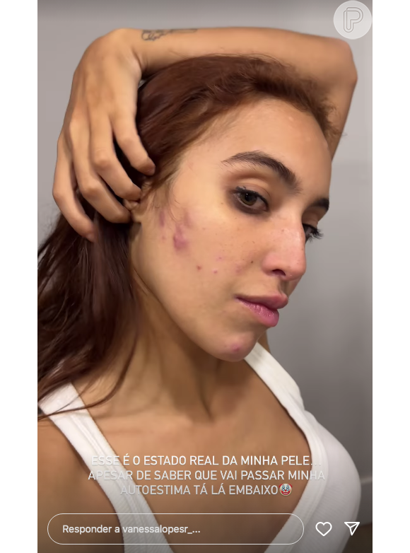 Vanessa Lopes atualizou suas redes sociais com um vídeo exibindo a atual situação do seu rosto