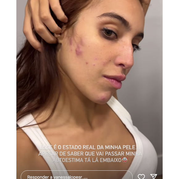 Vanessa Lopes atualizou suas redes sociais com um vídeo exibindo a atual situação do seu rosto