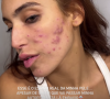 Acnes de Vanessa Lopes estão avançadas e, segundo a influenciadora, acabando com sua autoestima