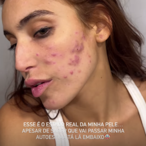 Acnes de Vanessa Lopes estão avançadas e, segundo a influenciadora, acabando com sua autoestima