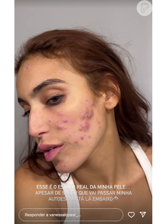 Acnes de Vanessa Lopes estão avançadas e, segundo a influenciadora, acabando com sua autoestima