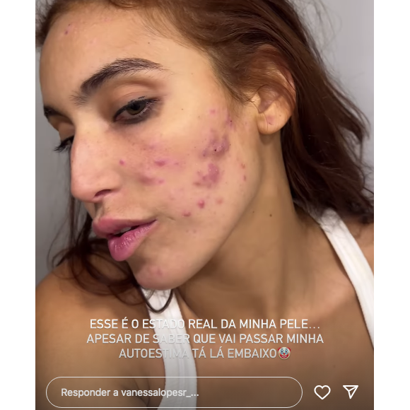 Acnes de Vanessa Lopes estão avançadas e, segundo a influenciadora, acabando com sua autoestima
