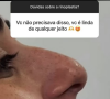 Respondendo perguntas de seguidores no Instagram, a ex-BBB 24 explicou que fez a rinoplastia para corrigir um desvio de septo