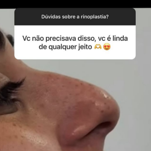 Respondendo perguntas de seguidores no Instagram, a ex-BBB 24 explicou que fez a rinoplastia para corrigir um desvio de septo