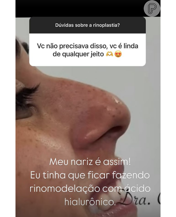 Respondendo perguntas de seguidores no Instagram, a ex-BBB 24 explicou que fez a rinoplastia para corrigir um desvio de septo