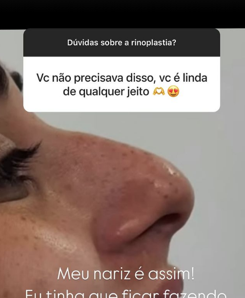 Respondendo perguntas de seguidores no Instagram, a ex-BBB 24 explicou que fez a rinoplastia para corrigir um desvio de septo