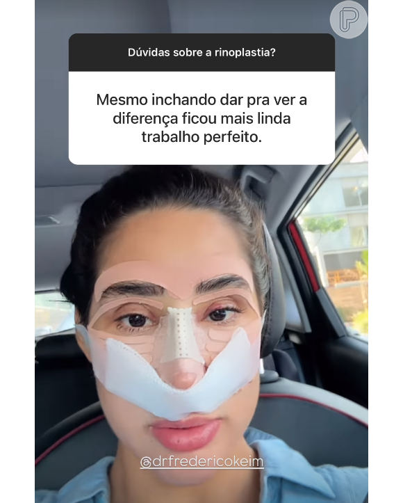 Resultado da rinoplastia de Deniziane Ferreira impressionou seus seguidores, mesmo com o rosto aind inchado e com curativos