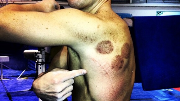 Diego Hypólito posta foto exibindo machucados de treino: 'Olha o tombo que deu'