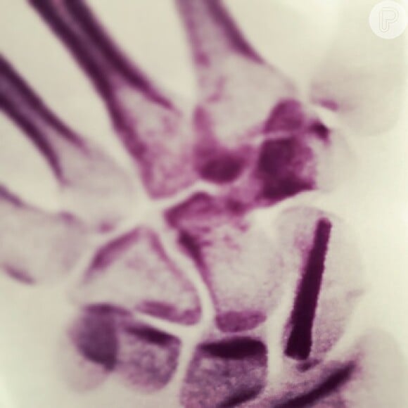 No Instagram, Nanda Costa compartilhou uma foto do raio-x da mão após a cirurgia: 'Entrei na faca. Agora tenho um parafuso a mais pra apertar!'