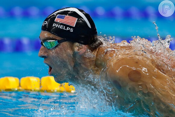 O nadador americano Michael Phelps surgiu com bolas vermelhas nos ombros e nas costas na Olimpíada Rio 2016 por recorrer a uma terapia oriental para amenizar a dor antes de competir