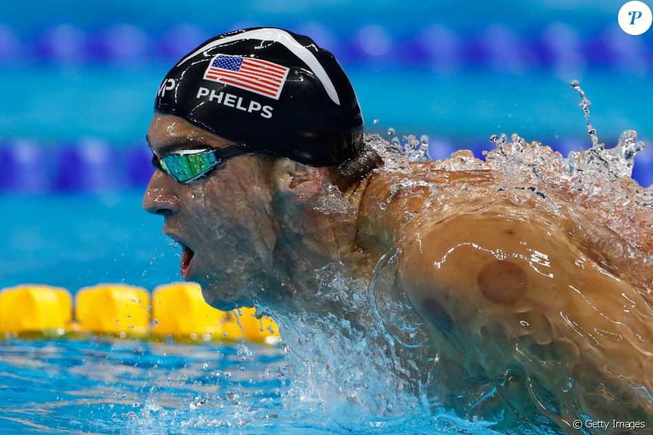 O nadador americano Michael Phelps surgiu com bolas vermelhas nos ombros e nas costas na Olimpíada Rio 2016 por recorrer a uma terapia oriental para amenizar a dor antes de competir