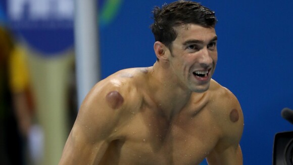 Entenda bolas vermelhas no corpo de Michael Phelps para amenizar dor na Rio 2016