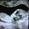 Contorno do rosto de Alexandre, primeiro filho de Ana Hickmann, pode ser visto em ultrassom