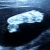 Em ultrassonografia, primeiro filho de Ana Hickmann mostra o pézinho