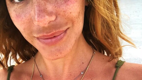 Mariana Goldfarb explica mancha no rosto após postar foto sem make: 'Melasma'